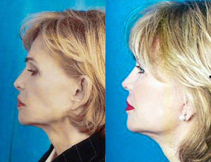 Revision Facelift