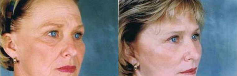 Revision Facelift