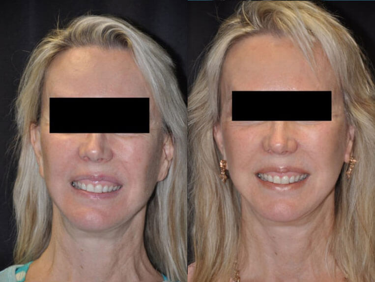 Revision Facelift