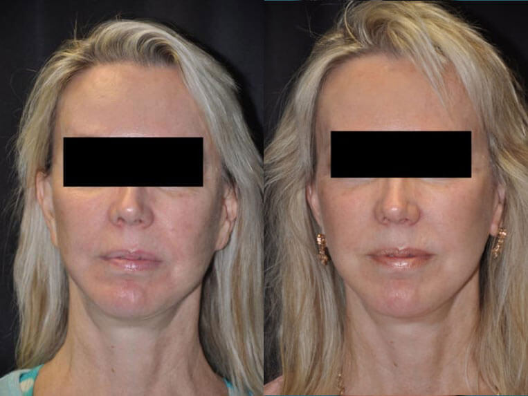 Revision Facelift