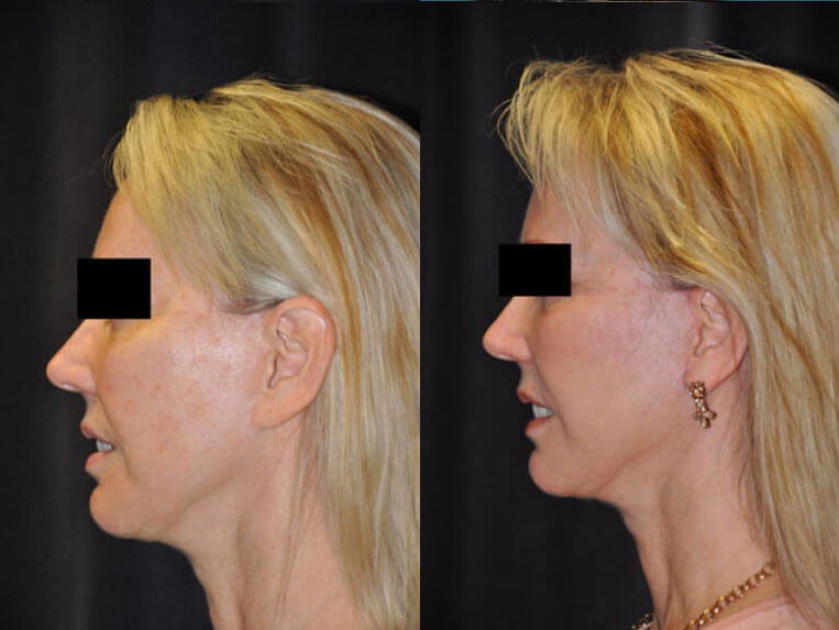 Revision Facelift