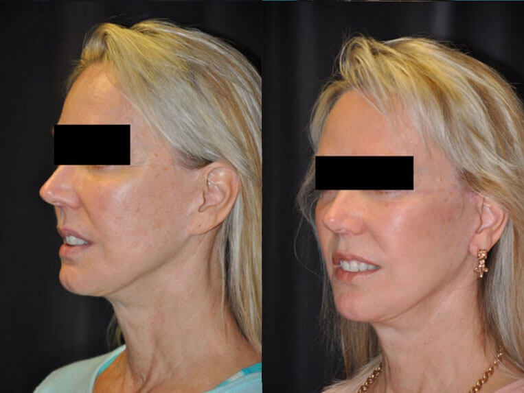 Revision Facelift