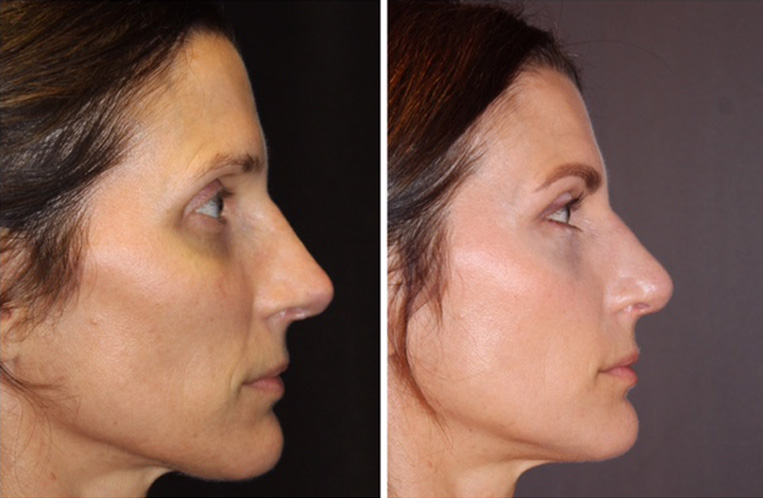 Rhinoplasty