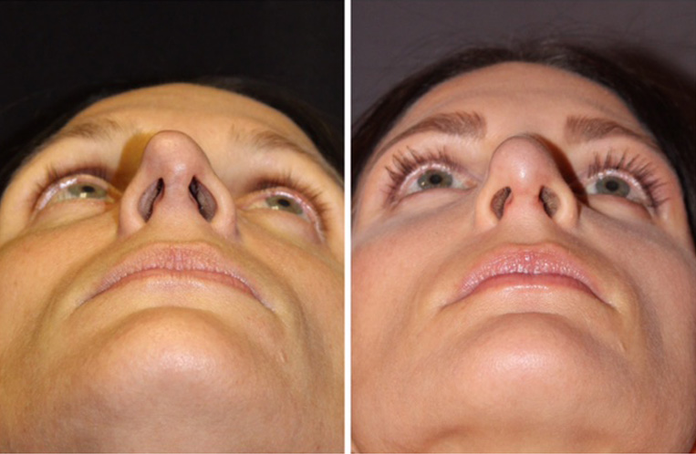 Rhinoplasty