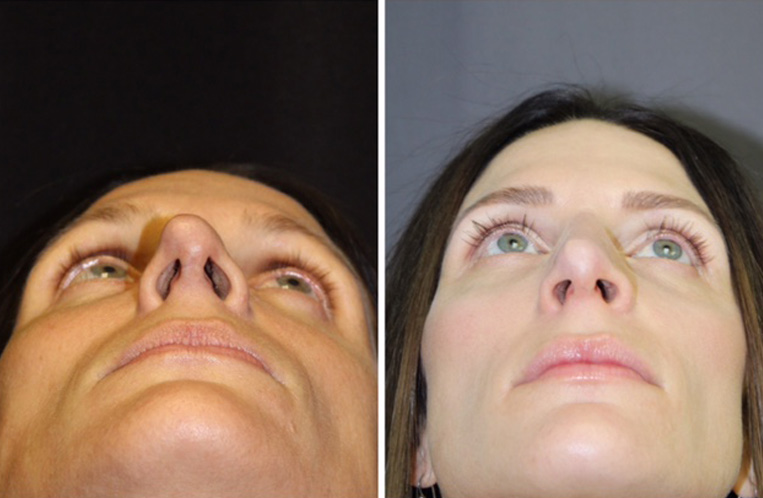 Rhinoplasty