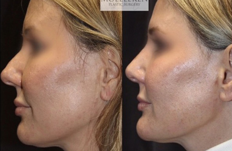 Rhinoplasty