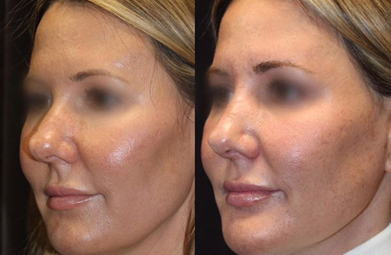 Rhinoplasty