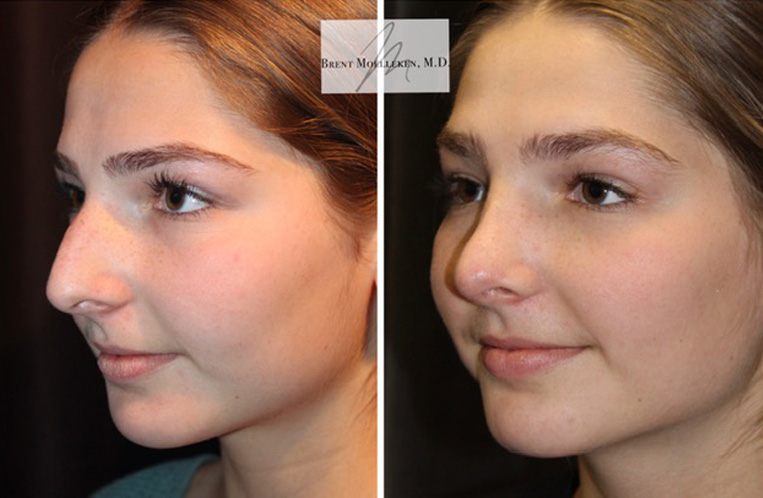 Rhinoplasty