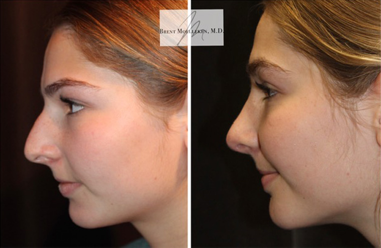 Rhinoplasty