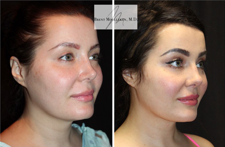 Rhinoplasty