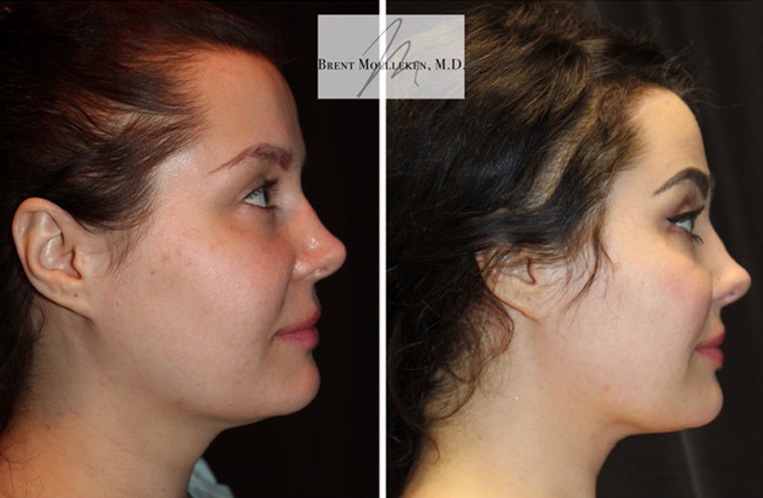 Rhinoplasty