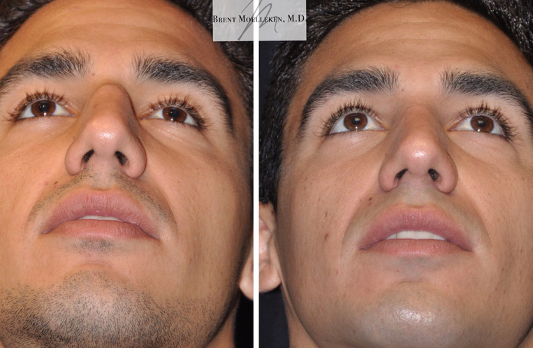 Rhinoplasty