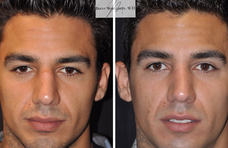 Rhinoplasty