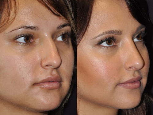 Rhinoplasty Beverly Hills