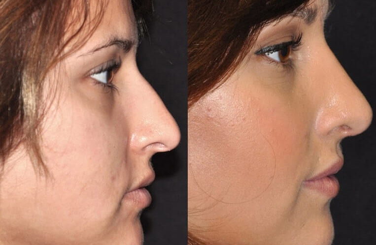 Rhinoplasty Beverly Hills