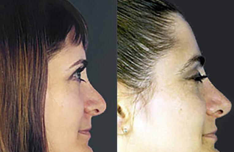 Rhinoplasty