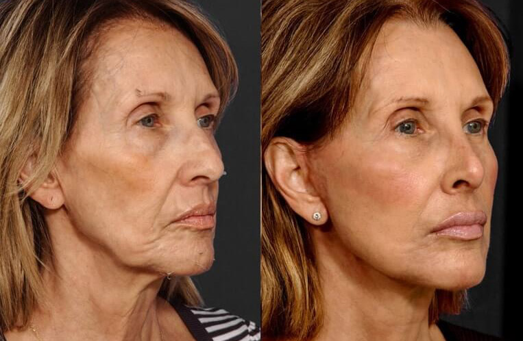 Face and neck-lift with neck-Lace procedure, superficial cheeklift with canthopexy, lower blepharoplasty, Livefill to naso labial folds, marionette, upper-lower lips, brows, DAO muscle release, rhinoplasty with tip plasty, lateral osteotomy, and dorsal reduction.