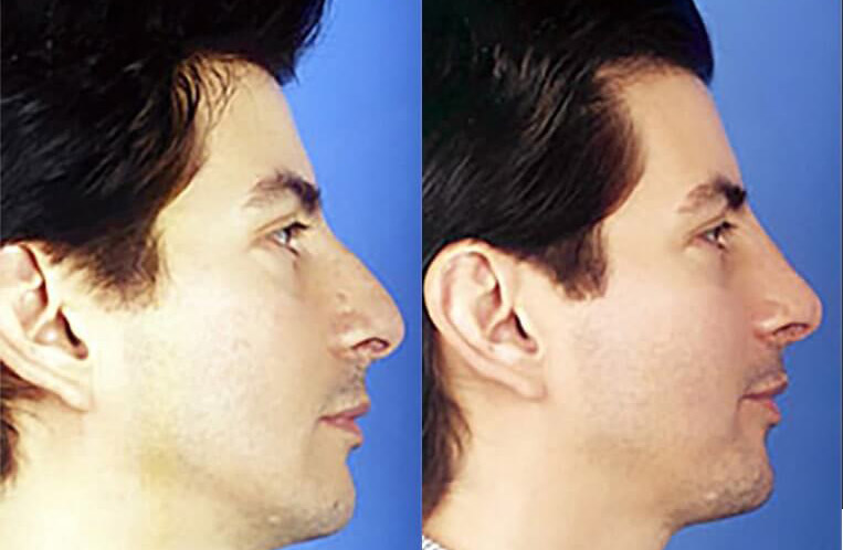 Rhinoplasty