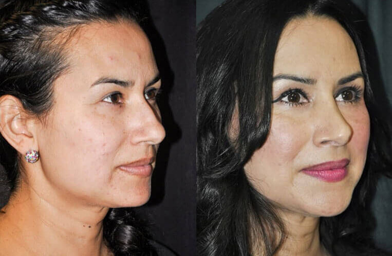 Rhinoplasty