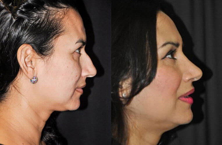 Rhinoplasty