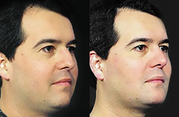 Chin implant, submental liposculpture with rhinoplasty.