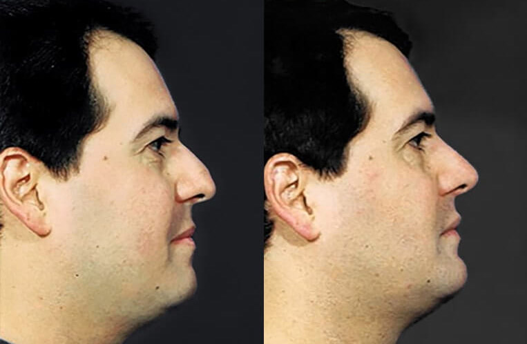 Chin implant, submental liposculpture with rhinoplasty.