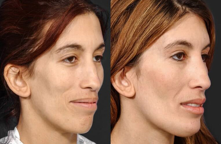 Rhinoplasty with osteotomy, columellar strut, dorsal reduction and chin implant.