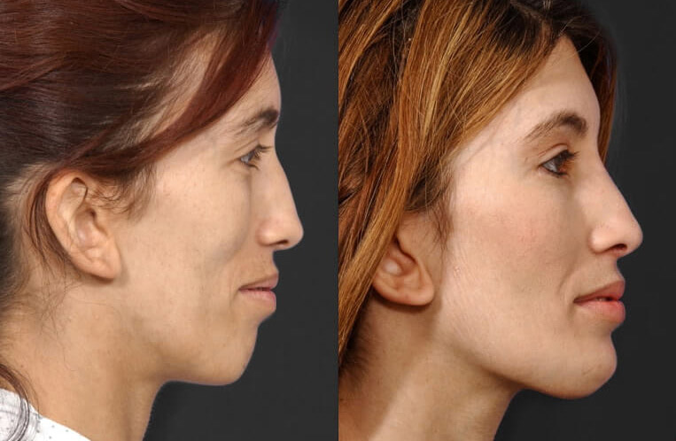 Rhinoplasty with osteotomy, columellar strut, dorsal reduction and chin implant.