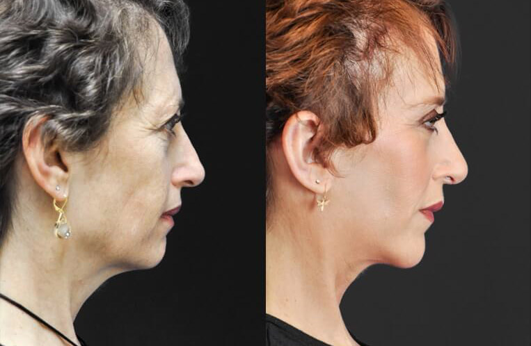 Rhinoplasty