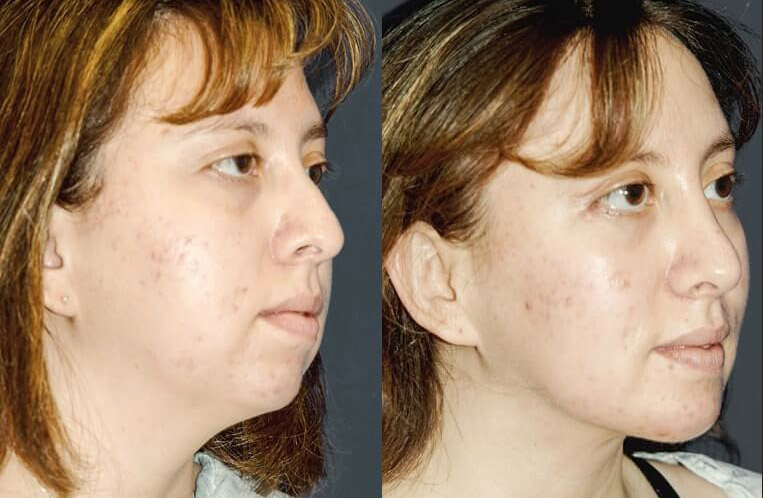 Buccal fat pad removal and submental liposculpture with rhinoplasty.