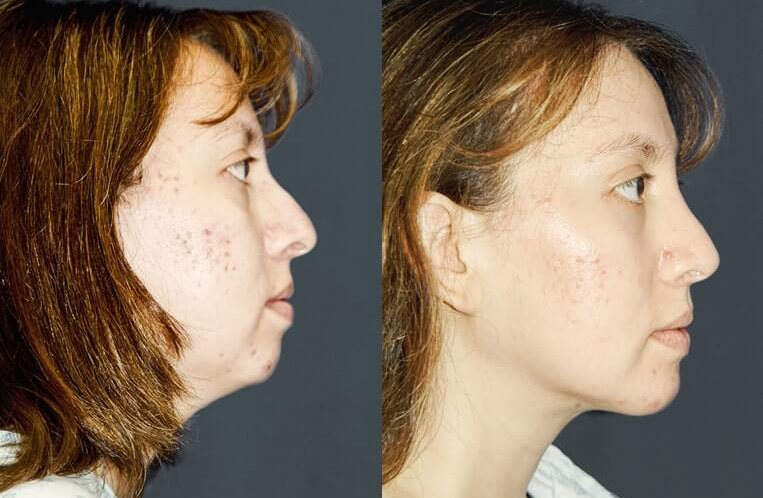 Buccal fat pad removal and submental liposculpture with rhinoplasty.