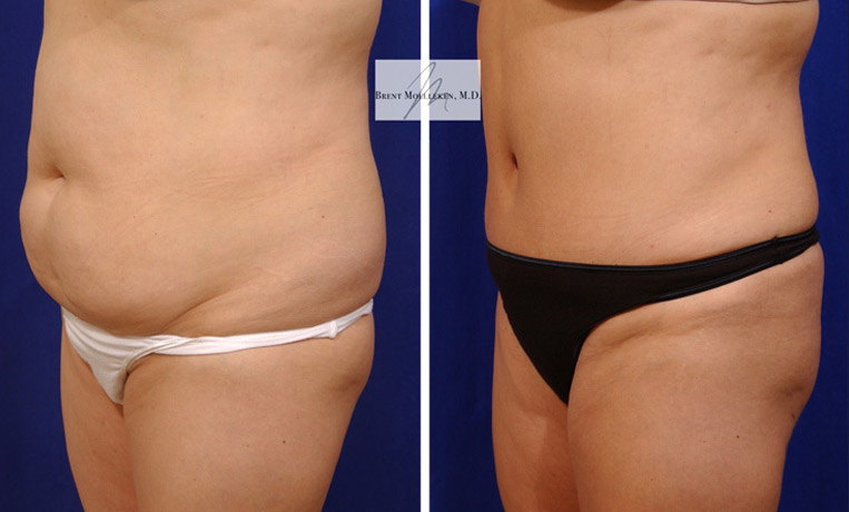 Tummy Tuck with Liposuction to Abdomen and Flanks