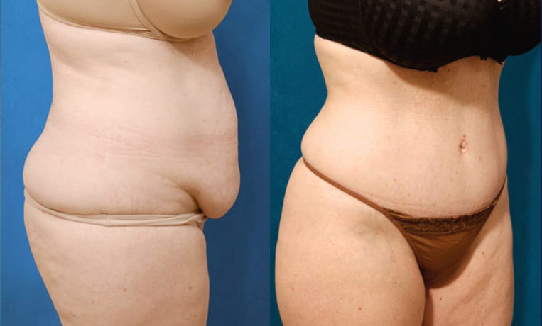 Tummy Tuck with Flank Extension, Diastasis Repair, Liposuction to Abdomen and Flanks