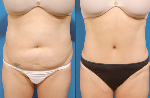 before-after-tummy-tuck-procedure-patient-1