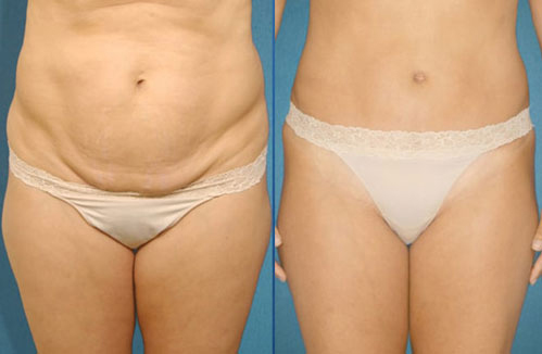 before-after-tummy-tuck-procedure-patient-2