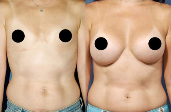 before after tummy tuck procedure patient 2