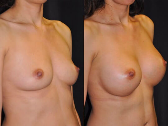 Breast Augmentation