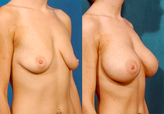 Breast augmentation with smooth saline implants, size 300cc – subpectoral placement/inframammary incision.