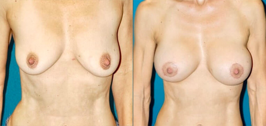 Breast augmentation with smooth saline implants, size 330cc.