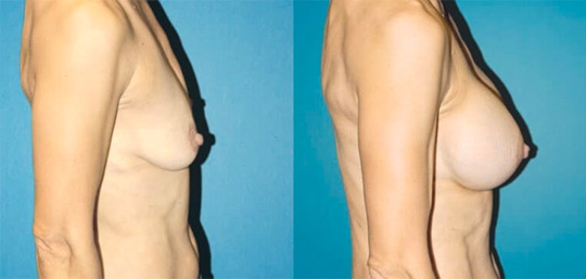 Breast augmentation with smooth saline implants, size 330cc.