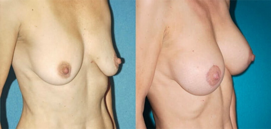 Breast augmentation with smooth saline implants, size 330cc.