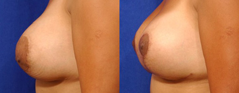 Breast and Nipple Reduction