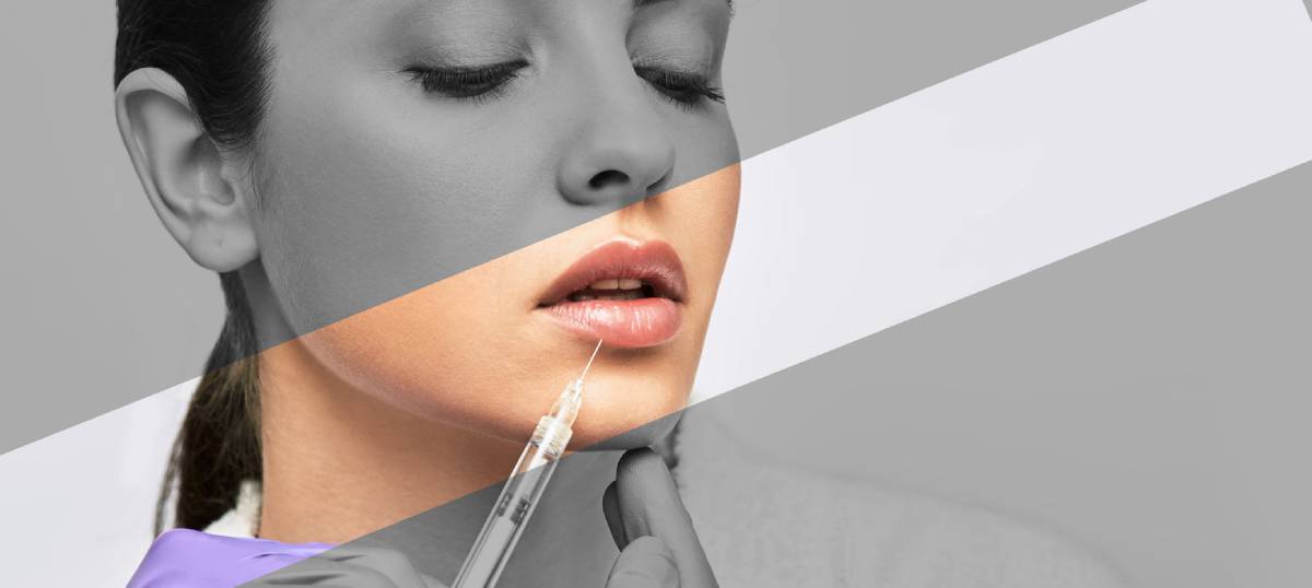 Featured image for Does Lip Augmentation Hurt