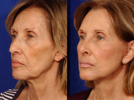 Facelift Necklace, USIC Cheeklift, Lateral Browlift, Livefill to Nasolabial Folds and Lips, Upper Lip Lift, Rhinoplasty Co2 Laser