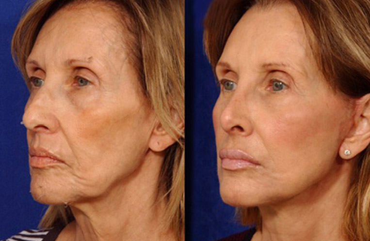 Facelift with Necklace, USIC Cheeklift, Lateral Browlift, Livefill to Naso Labial Folds and Lips, Upper Lip Lift, Rhinoplasty, Co2 Laser