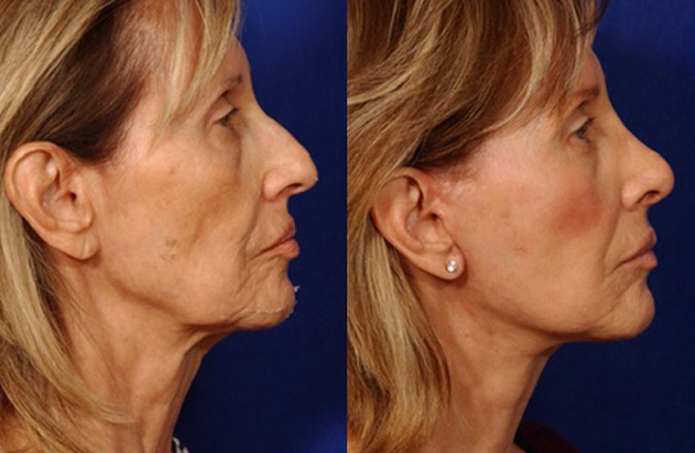 Facelift with Necklace, USIC Cheeklift, Lateral Browlift, Livefill to Naso Labial Folds and Lips, Upper Lip Lift, Rhinoplasty, Co2 Laser