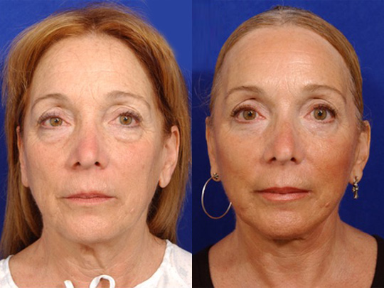 Facelift with Necklace, Lateral Browlift, USIC Cheeklift with Transconjunctival Lower Blepharoplasty, Livefill to Lips, Livefill to Nasolabial Folds, Co2 Laser to Face.