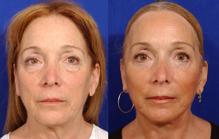 Facelift with Necklace, Lateral Browlift, USIC Cheeklift with Transconjunctival Lower Blepharoplasty, Livefill to Lips, Livefill to Nasolabial Folds, Co2 Laser to Face.