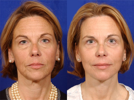 Facelift with Necklace, Lateral Browlift, USIC Cheeklift with Transconjunctival Lower Blepharoplasty, Livefill to Lips, Livefill to Nasolabial Folds, Co2 to Face and Neck