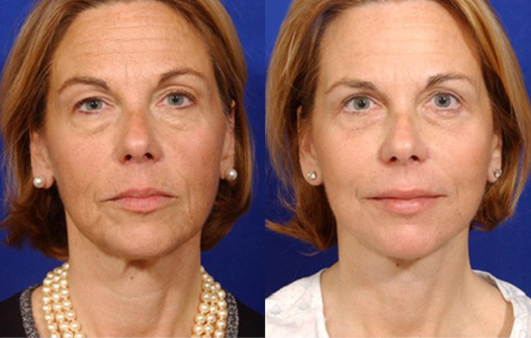 Facelift with Necklace, Lateral Browlift, USIC Cheeklift with Transconjunctival Lower Blepharoplasty, Livefill to Lips, Livefill to Nasolabial Folds, Co2